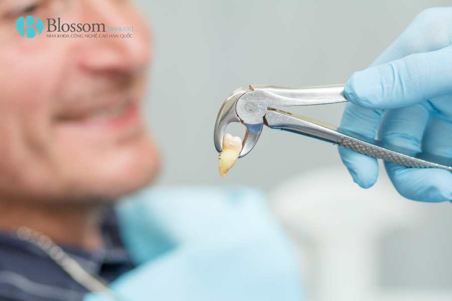 Mới nhổ răng ăn thịt bò được không? Kiêng bao lâu là tốt nhất 3 moi nho rang an thit bo duoc khong 3