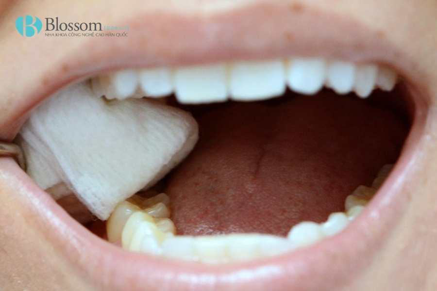 Mới nhổ răng ăn thịt bò được không? Kiêng bao lâu là tốt nhất 5 moi nho rang an thit bo duoc khong 5