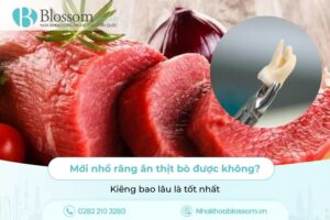 Mới nhổ răng ăn thịt bò được không? Kiêng bao lâu là tốt nhất