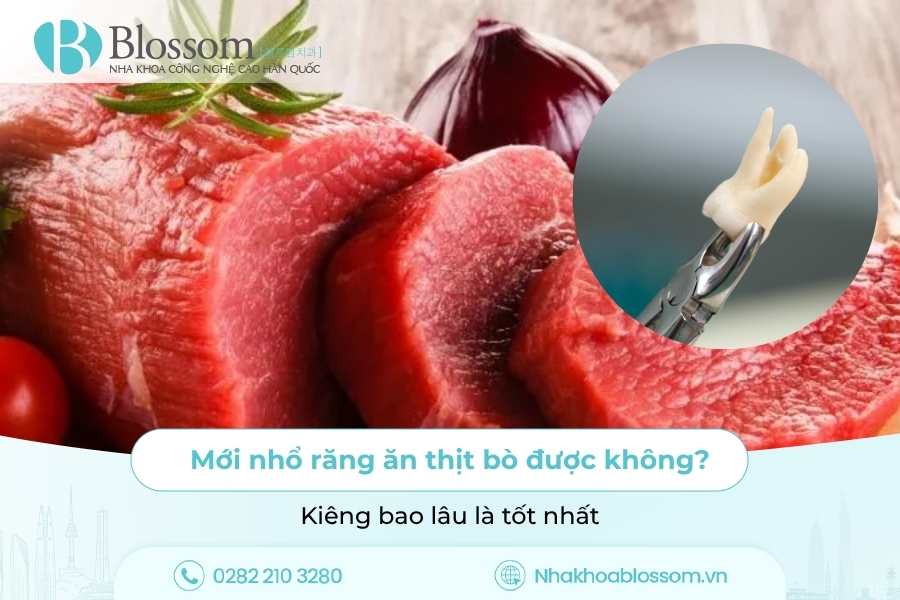 Mới nhổ răng ăn thịt bò được không? Kiêng bao lâu là tốt nhất