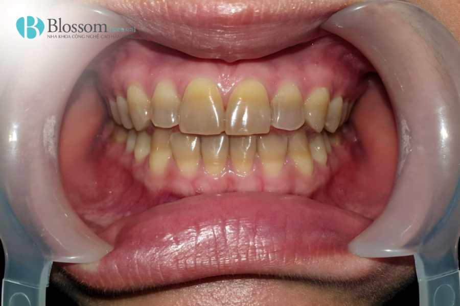 Răng bị đổi màu là do đâu? Nguyên nhân, dấu hiệu và cách cải thiện hiệu quả 1 rang bi doi mau 1