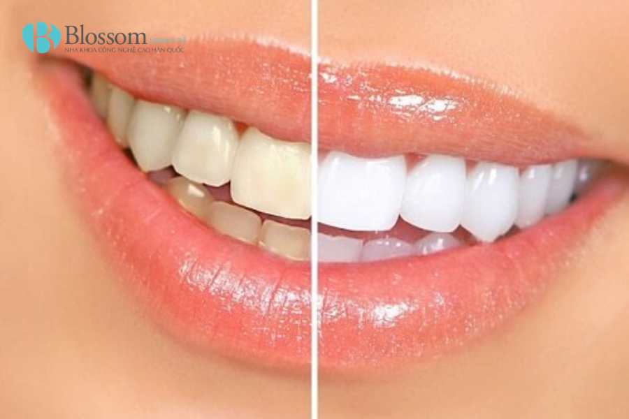 Răng bị đổi màu là do đâu? Nguyên nhân, dấu hiệu và cách cải thiện hiệu quả 3 rang bi doi mau 3
