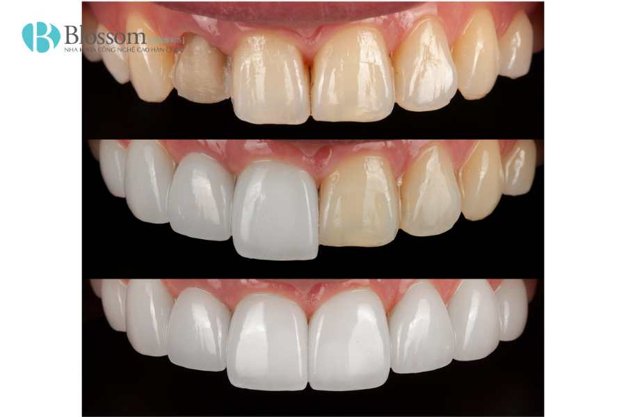 Răng bị đổi màu là do đâu? Nguyên nhân, dấu hiệu và cách cải thiện hiệu quả 4 rang bi doi mau 4