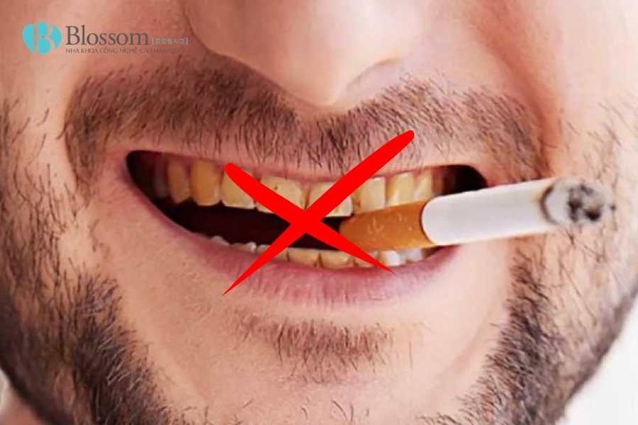 Răng bị đổi màu là do đâu? Nguyên nhân, dấu hiệu và cách cải thiện hiệu quả 5 rang bi doi mau 5