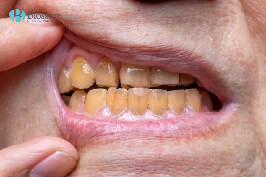 rang nhiem tetracycline 1