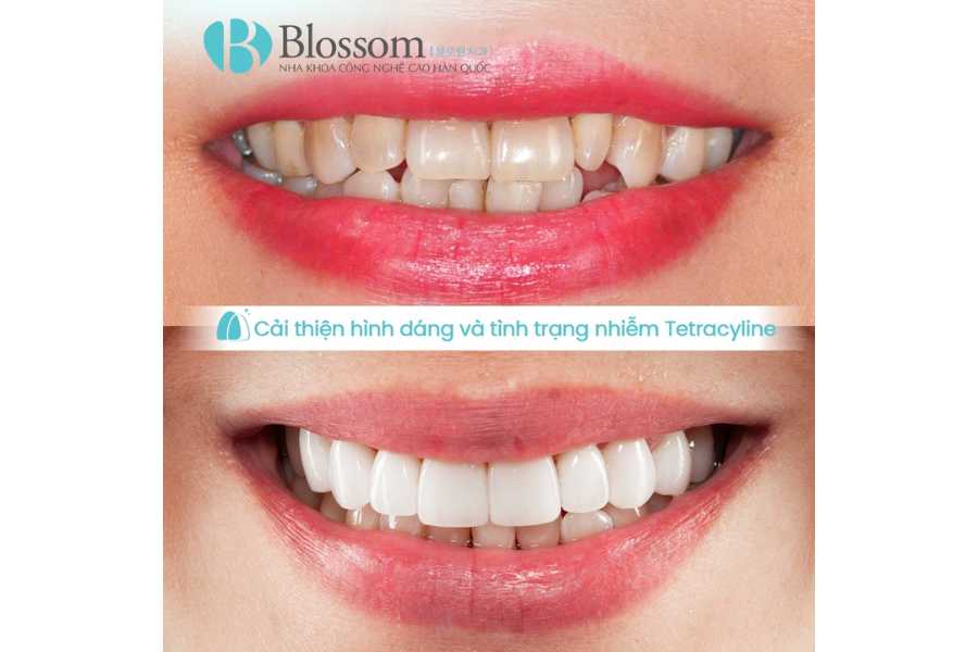 rang nhiem tetracycline 4