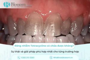 Răng nhiễm Tetracycline có chữa được không? Sự thật và giải pháp phù hợp nhất cho từng trường hợp