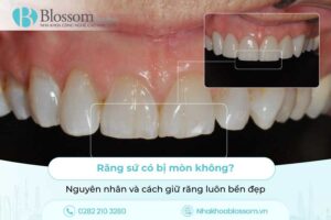 Răng sứ có bị mòn không? Nguyên nhân và cách giữ răng luôn bền đẹp