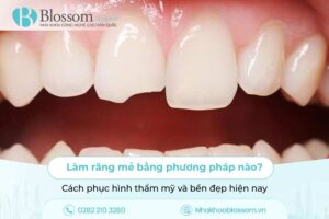 Làm răng mẻ bằng phương pháp nào? Cách phục hình thẩm mỹ và bền đẹp hiện nay