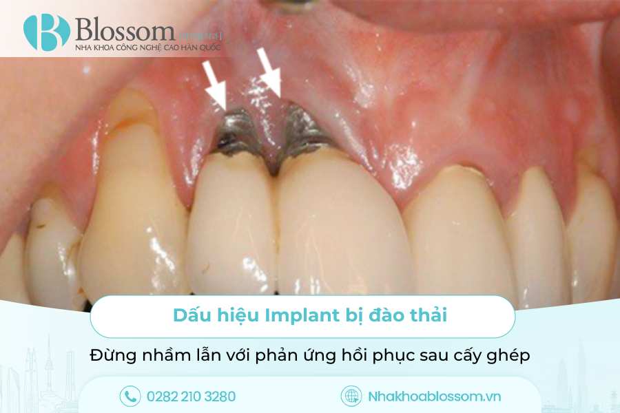 Dấu hiệu Implant bị đào thải: Đừng nhầm lẫn với phản ứng hồi phục sau cấy ghép
