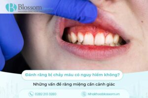 Đánh răng bị chảy máu có nguy hiểm không? Những vấn đề răng miệng cần cảnh giác