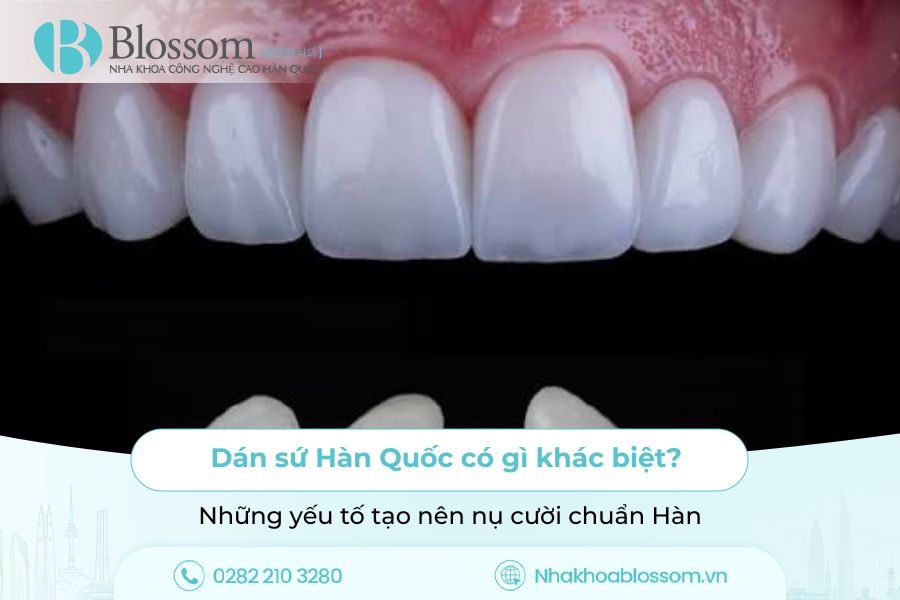 Dán sứ Hàn Quốc có gì khác biệt? Những yếu tố tạo nên nụ cười chuẩn Hàn