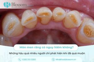 Mòn men răng có nguy hiểm không? Những hậu quả nhiều người chỉ phát hiện khi đã quá muộn