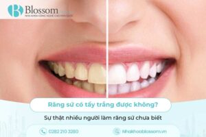 Răng sứ có tẩy trắng được không? Sự thật nhiều người làm răng sứ chưa biết