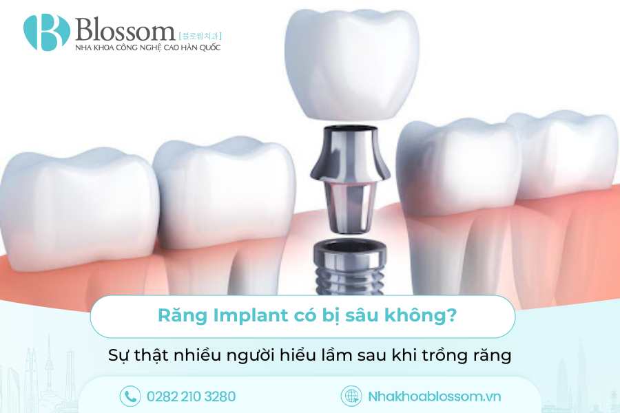 Răng Implant có bị sâu không? Sự thật nhiều người hiểu lầm sau khi trồng răng