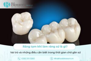 Răng tạm khi làm răng sứ là gì? Vai trò và những điều cần biết trong thời gian chờ gắn sứ