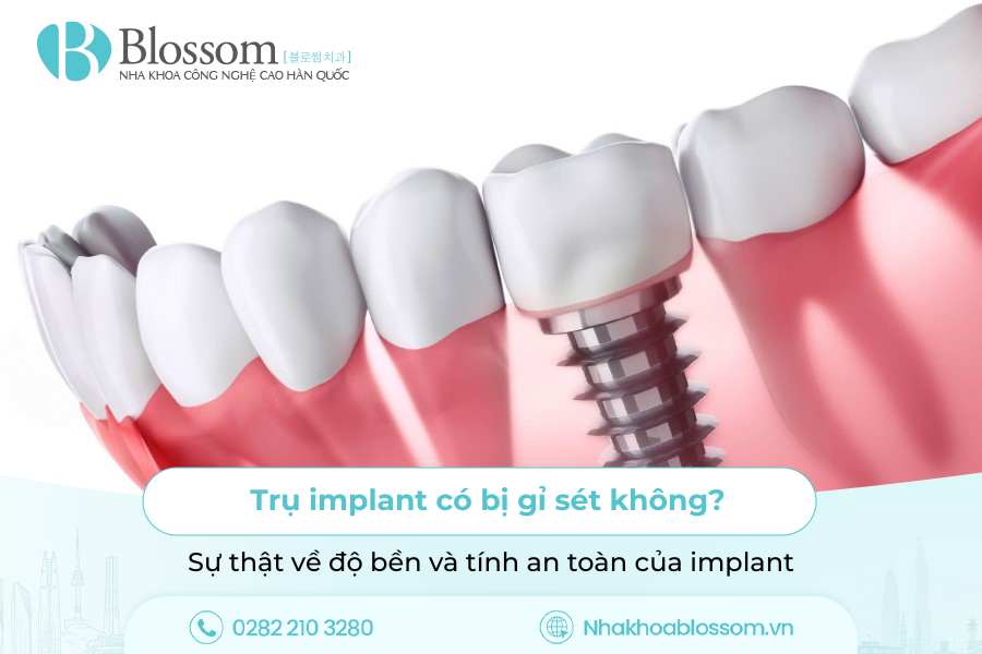 Trụ implant có bị gỉ sét không? Sự thật về độ bền và tính an toàn của implant