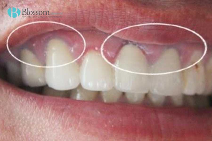 Dán sứ có lộ viền nướu sau 1 - 2 năm không? Góc nhìn chuyên môn từ kỹ thuật thực hiện 1 dan su co lo vien nuou sau 1 2 nam khong 1