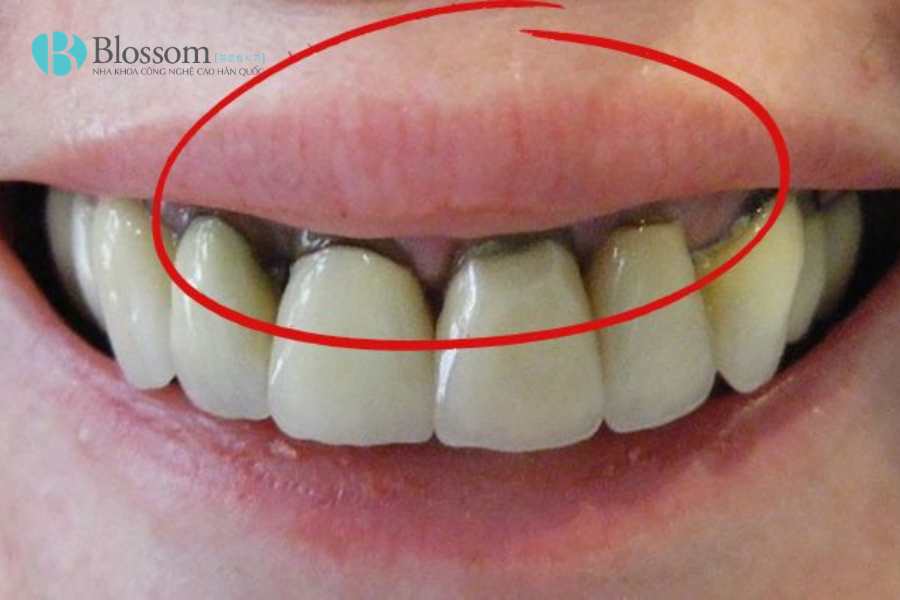 Dán sứ có lộ viền nướu sau 1 - 2 năm không? Góc nhìn chuyên môn từ kỹ thuật thực hiện 2 dan su co lo vien nuou sau 1 2 nam khong 2