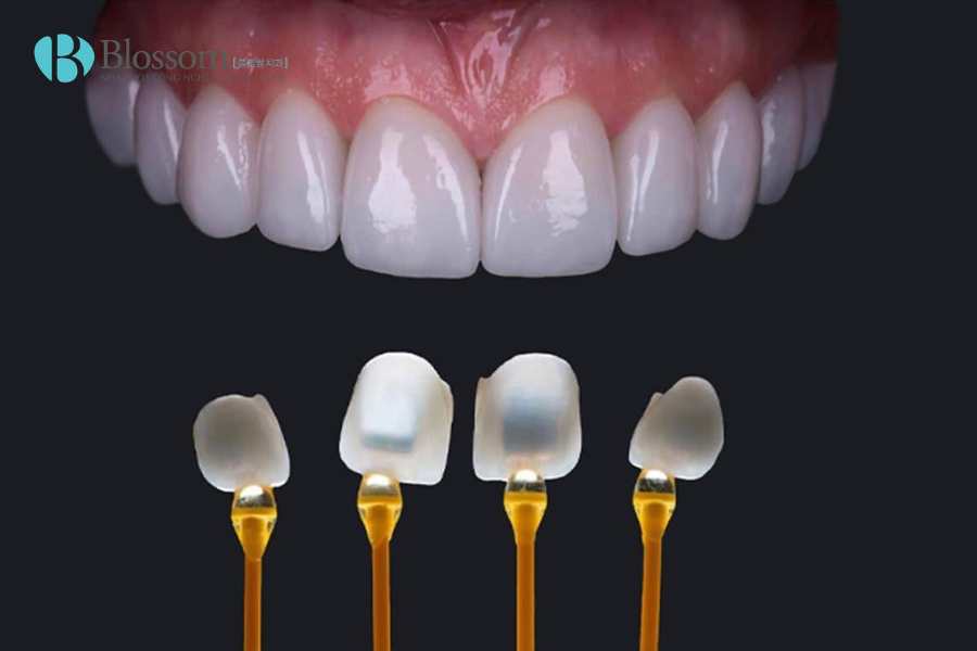 Dán sứ có lộ viền nướu sau 1 - 2 năm không? Góc nhìn chuyên môn từ kỹ thuật thực hiện 3 dan su co lo vien nuou sau 1 2 nam khong 3