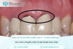 Dán sứ có lộ viền nướu sau 1 – 2 năm không? Góc nhìn chuyên môn từ kỹ thuật thực hiện