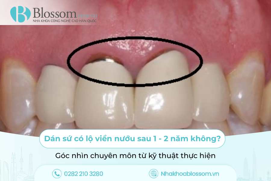 Dán sứ có lộ viền nướu sau 1 – 2 năm không? Góc nhìn chuyên môn từ kỹ thuật thực hiện
