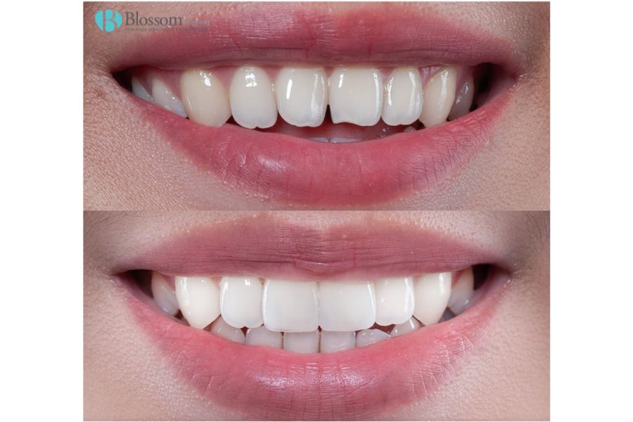 Không còn chuộng răng trắng đều: Vì sao xu hướng dán sứ thế hệ mới được sao Hàn yêu thích? 1 dan su the he moi 1