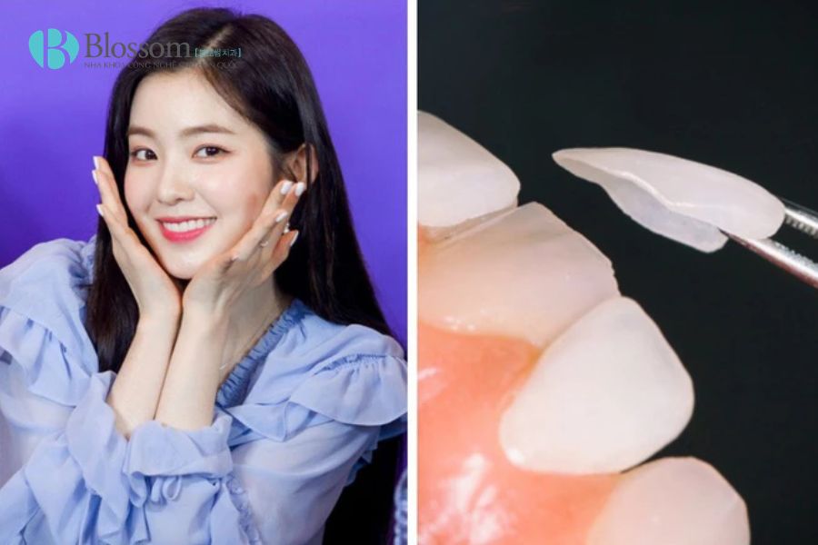 Không còn chuộng răng trắng đều: Vì sao xu hướng dán sứ thế hệ mới được sao Hàn yêu thích? 3 dan su the he moi 3