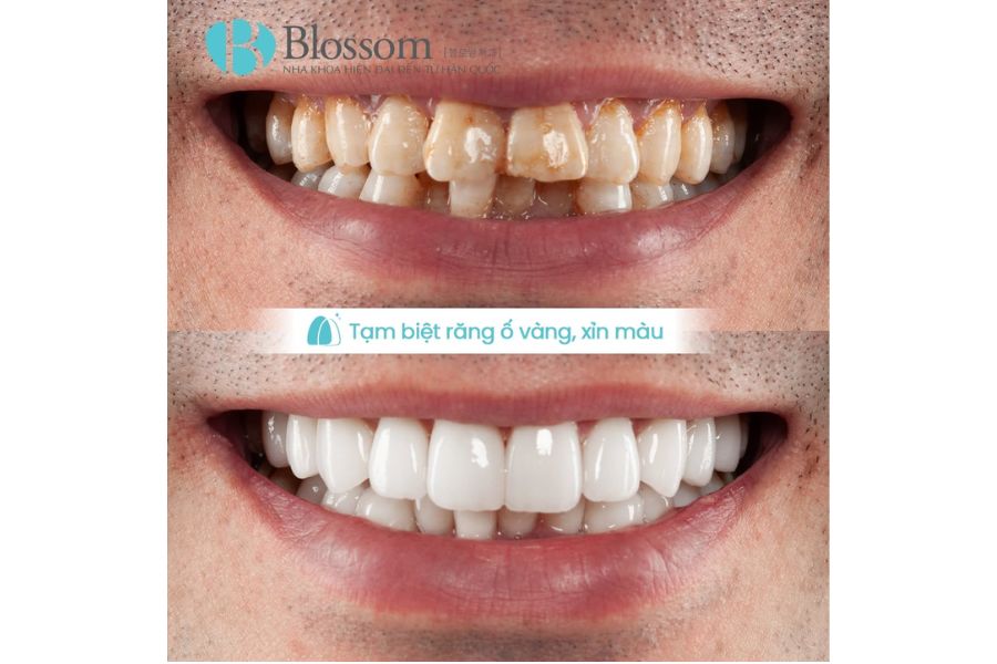Không còn chuộng răng trắng đều: Vì sao xu hướng dán sứ thế hệ mới được sao Hàn yêu thích? 4 dan su the he moi 4