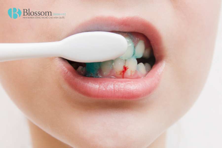 Đánh răng bị chảy máu có nguy hiểm không? Những vấn đề răng miệng cần cảnh giác 1 danh rang bi chay mau 1