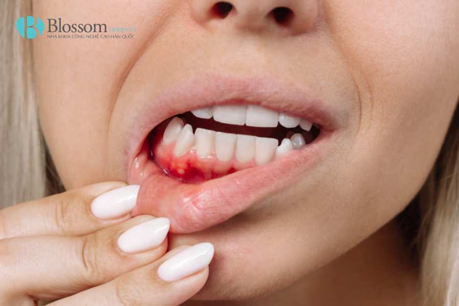 Đánh răng bị chảy máu có nguy hiểm không? Những vấn đề răng miệng cần cảnh giác 2 danh rang bi chay mau 2