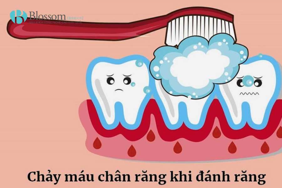 Đánh răng bị chảy máu có nguy hiểm không? Những vấn đề răng miệng cần cảnh giác 4 danh rang bi chay mau 4