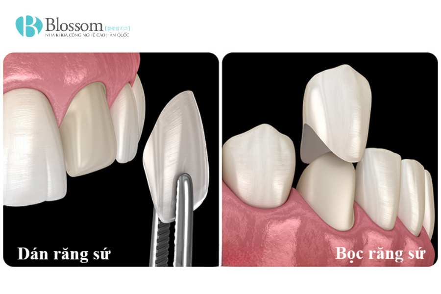Đắp răng sứ là gì? Trường hợp nào nên thực hiện và những điều cần biết 1 dap rang su 1