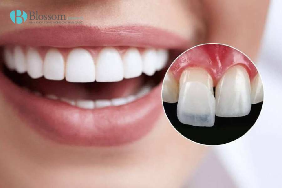 Đắp răng sứ là gì? Trường hợp nào nên thực hiện và những điều cần biết 2 dap rang su 2