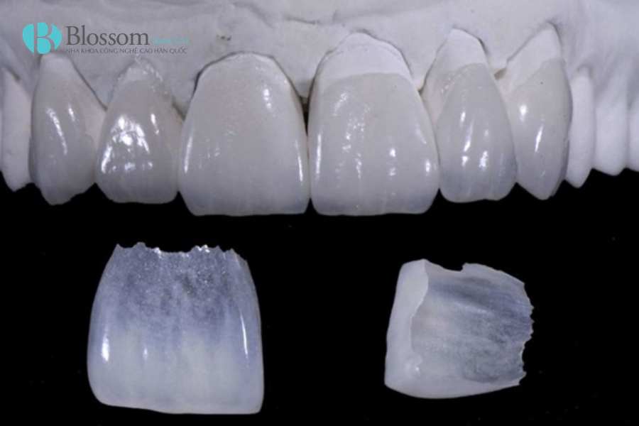 Đắp răng sứ là gì? Trường hợp nào nên thực hiện và những điều cần biết 3 dap rang su 4