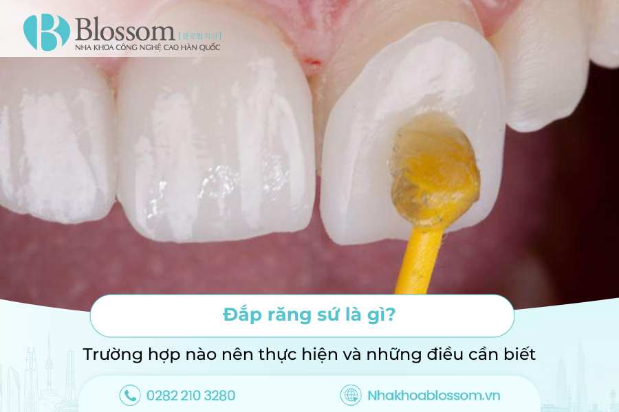 Đắp răng sứ là gì? Trường hợp nào nên thực hiện và những điều cần biết