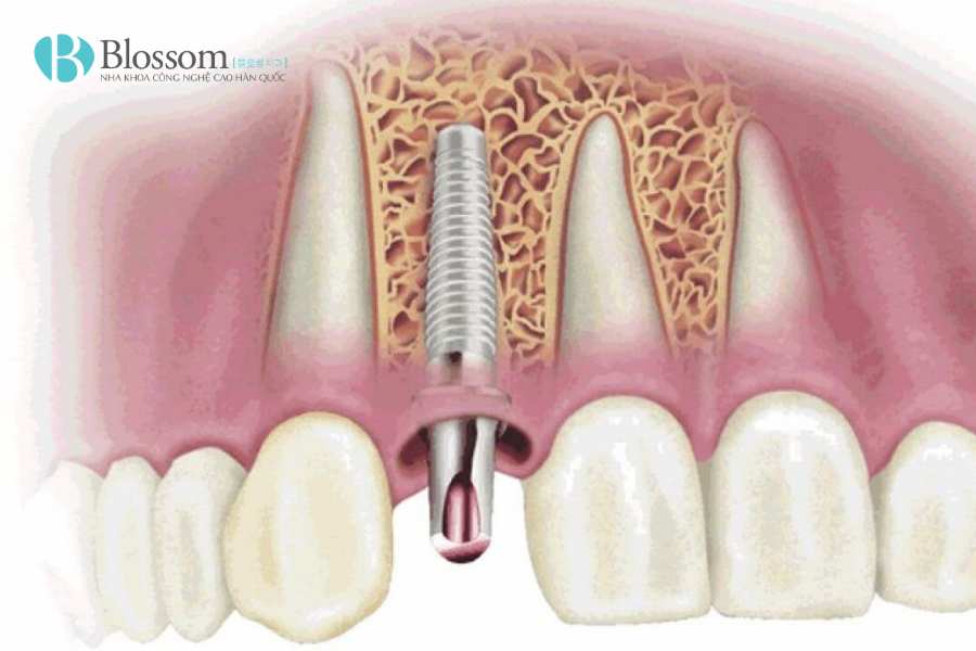Dấu hiệu Implant bị đào thải: Đừng nhầm lẫn với phản ứng hồi phục sau cấy ghép 1 dau hieu implant bi dao thai 1