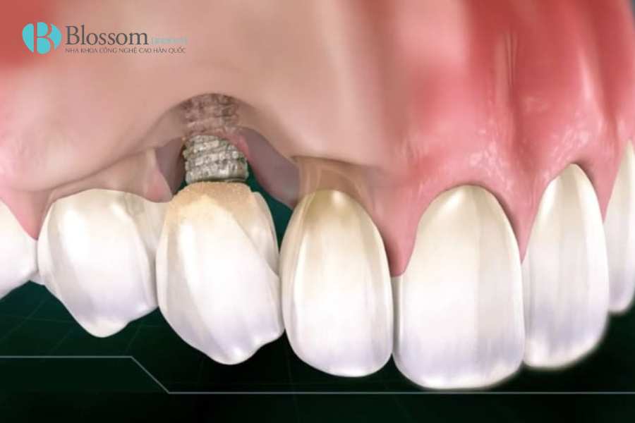 Dấu hiệu Implant bị đào thải: Đừng nhầm lẫn với phản ứng hồi phục sau cấy ghép 2 dau hieu implant bi dao thai 2