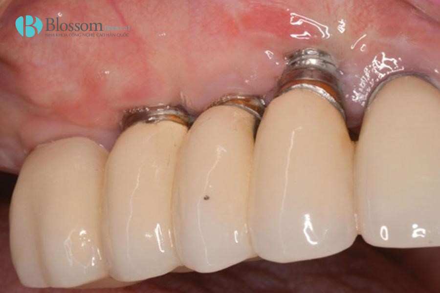 Dấu hiệu Implant bị đào thải: Đừng nhầm lẫn với phản ứng hồi phục sau cấy ghép 3 dau hieu implant bi dao thai 3