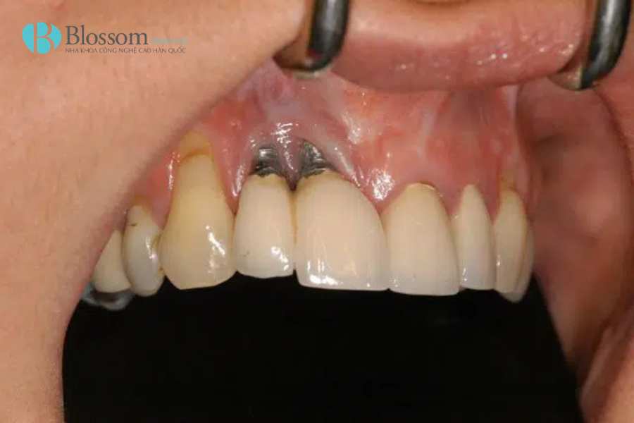 Dấu hiệu Implant bị đào thải: Đừng nhầm lẫn với phản ứng hồi phục sau cấy ghép 4 dau hieu implant bi dao thai 4