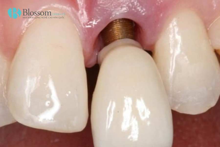 Dấu hiệu Implant bị đào thải: Đừng nhầm lẫn với phản ứng hồi phục sau cấy ghép 5 dau hieu implant bi dao thai 5