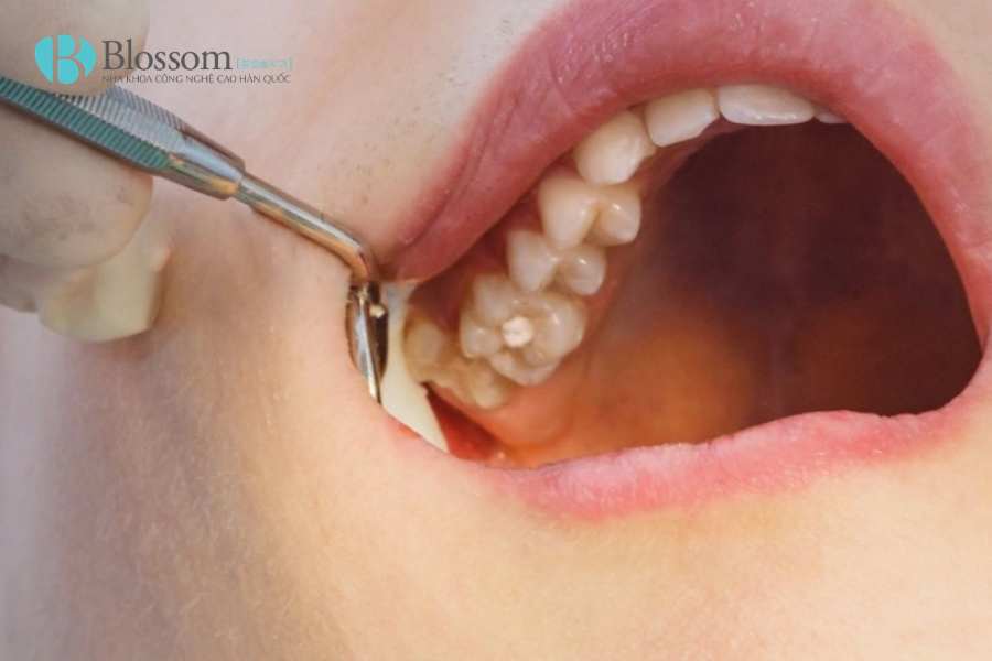Dấu hiệu thường gặp khi mọc răng khôn: Khi nào là bình thường, khi nào là tín hiệu nguy hiểm? 4 dau hieu thuong gap khi moc rang khon 4