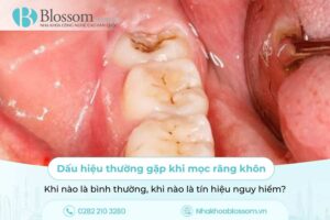 Dấu hiệu thường gặp khi mọc răng khôn: Khi nào là bình thường, khi nào là tín hiệu nguy hiểm?