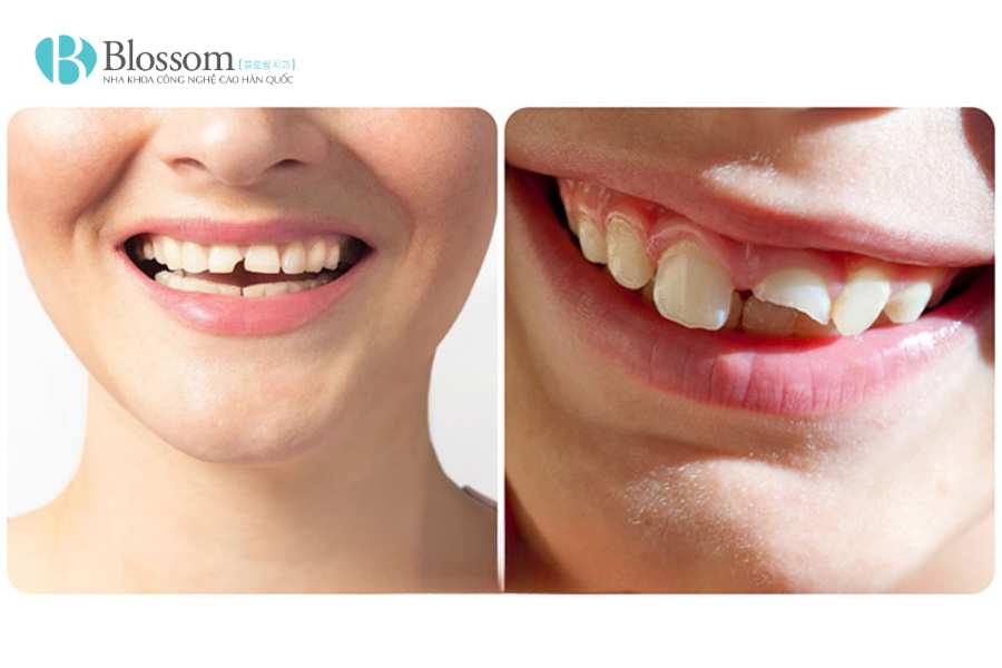 Làm răng mẻ bằng phương pháp nào? Cách phục hình thẩm mỹ và bền đẹp hiện nay 1 lam rang me 1