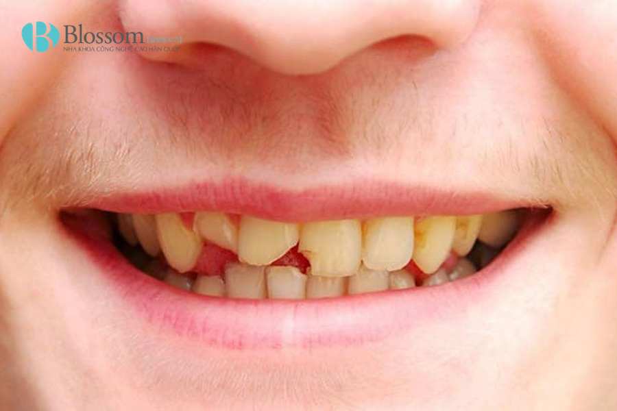 Làm răng mẻ bằng phương pháp nào? Cách phục hình thẩm mỹ và bền đẹp hiện nay 2 lam rang me 2