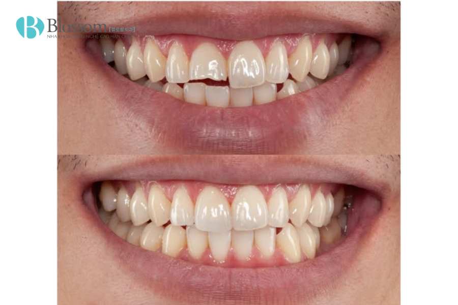 Làm răng mẻ bằng phương pháp nào? Cách phục hình thẩm mỹ và bền đẹp hiện nay 4 lam rang me 4