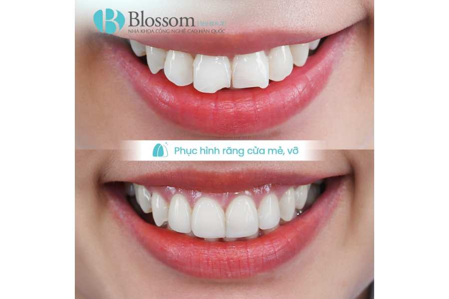Làm răng mẻ bằng phương pháp nào? Cách phục hình thẩm mỹ và bền đẹp hiện nay 5 lam rang me 5