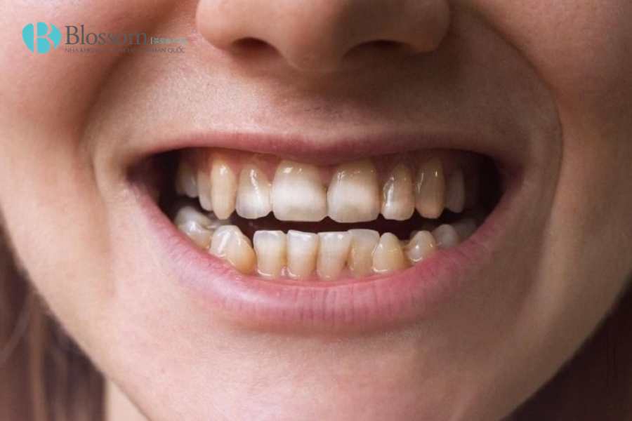 Mòn men răng có nguy hiểm không? Những hậu quả nhiều người chỉ phát hiện khi đã quá muộn 2 mon men rang 2