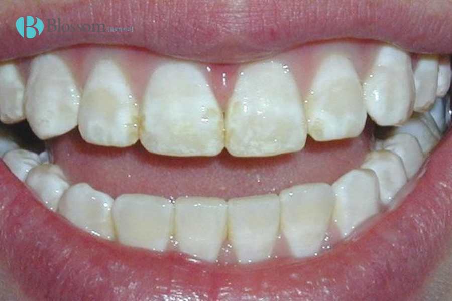 Mòn men răng có nguy hiểm không? Những hậu quả nhiều người chỉ phát hiện khi đã quá muộn 3 mon men rang 3