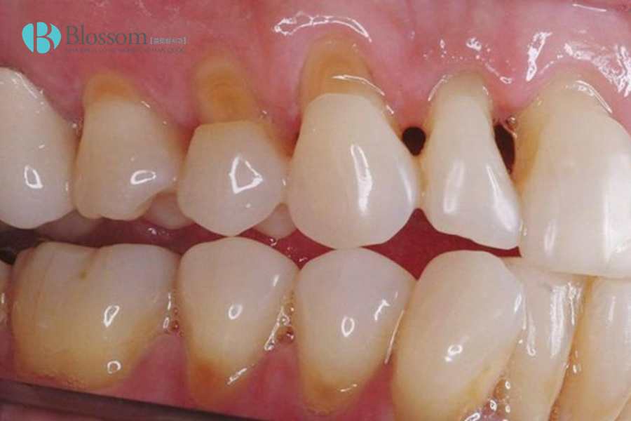 Mòn men răng có nguy hiểm không? Những hậu quả nhiều người chỉ phát hiện khi đã quá muộn 4 mon men rang 4